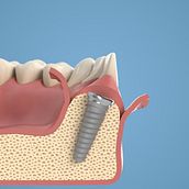 Dental Animations. 3D Animation project by Andres - 03.19.2021