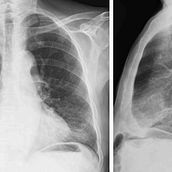 Clasificación de Imágenes de Radiografías de Torax de Pacientes con Covid, con Neumonía y sin padecimientos Ein Projekt aus dem Bereich Programmierung und Künstliche Intelligenz von Daniel Ramírez - 06.02.2024