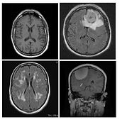 Clasificación de MRI cerebral para determinar la existencia (o no) de tumores cerebrales. Programming, Web Development, and Artificial Intelligence project by Lorenzo Mazzante - 06.06.2024