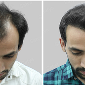 Transform Your Look with Eyebrow Hair Transplant Delhi. Projekt z dziedziny  Motion graphics użytkownika satya hairsolutions - 08.07.2024