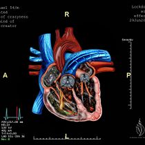 My project in Surrealistic Photomontage with Photoshop  course -"Biomechanical heart and Heart Attack Scan !!" Ein Projekt aus dem Bereich 2-D-Animation, Digitale Illustration und Digitalfotografie von Mahendra Singh Chouhan - 30.06.2020