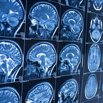 Brain Tumor Classifier Based on MRI . Un proyecto de Desarrollo Web, Programación, Inteligencia Artificial e IA para programación de jonathanvegeta11 - 25.01.2025