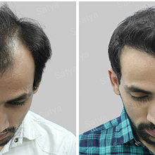 Your Premier Destination for Hair Transplants in Mumbai. Projekt z dziedziny Podcasting użytkownika satya hairsolutions - 15.06.2024