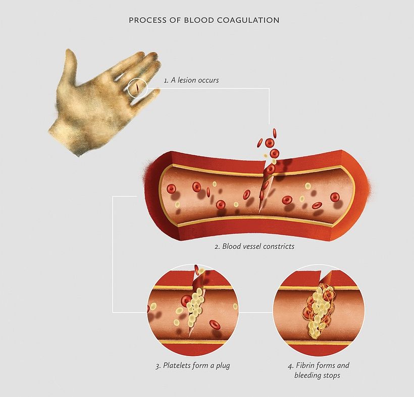 Basic Guide of Hemophilia 2