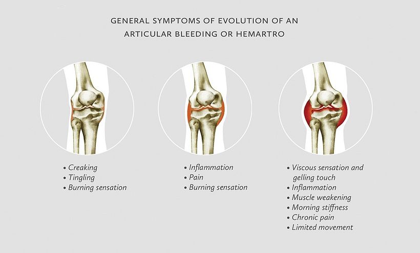 Basic Guide of Hemophilia 5