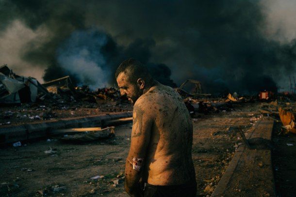 Injured Man After Port Explosion in Beirut, by Lorenzo Tugnoli.