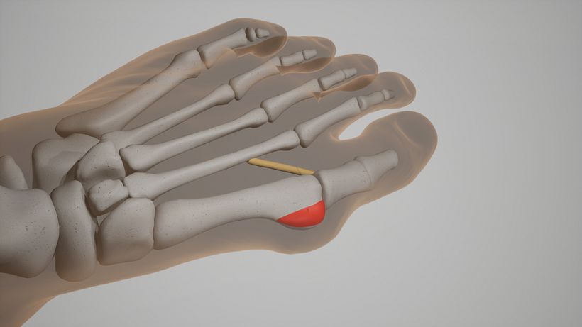 simulación 3D operación medica  5