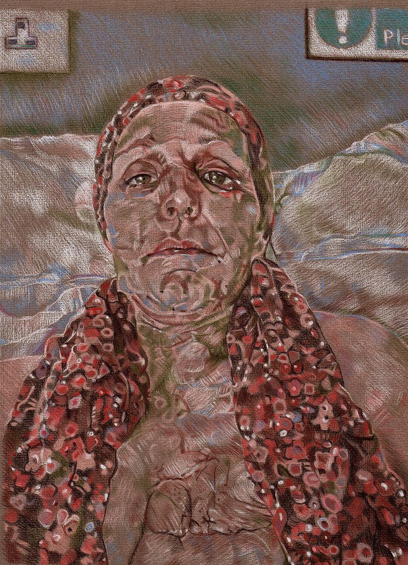 When they took the dressings off 2