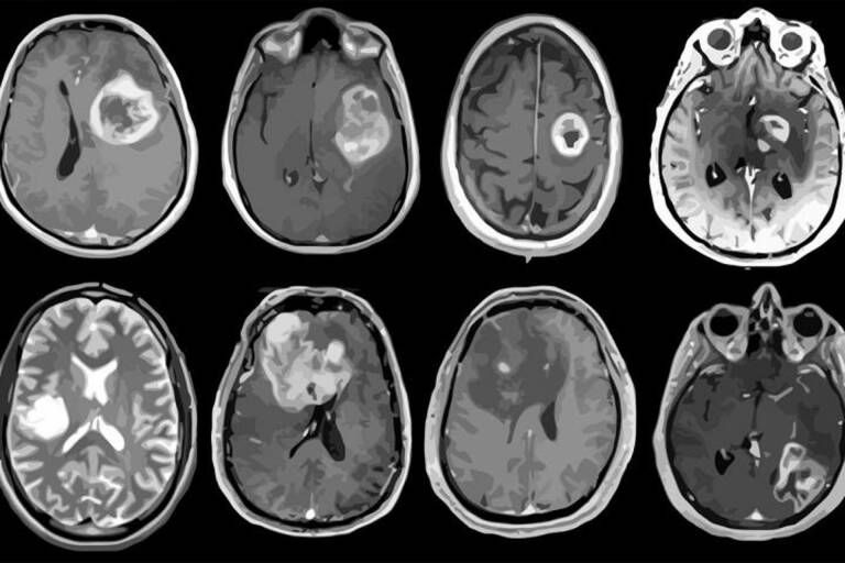 Brain Tumor Classifier Based on MRI 1