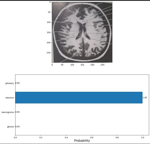 Brain Tumor Classifier Based on MRI 9